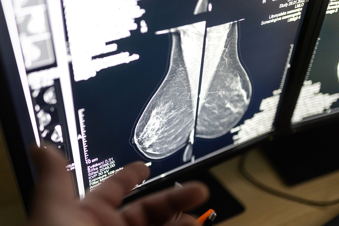 Mamocentrum Svitavy přijímá poukázky na vyšetření prsu